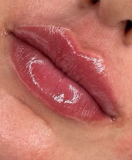 Lip filler after treatment — natural result by Dr. Soheila Eskandari, Dubai