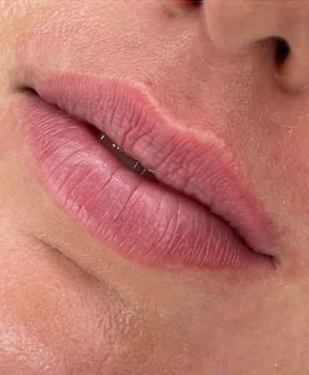 Lip filler before treatment — patient of Dr. Soheila Eskandari, Dubai