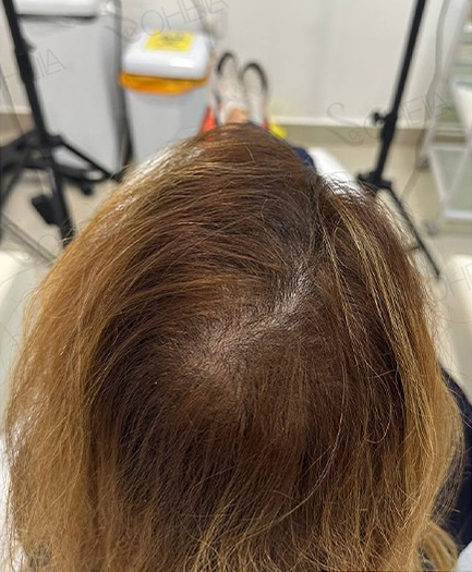 Hair Loss after