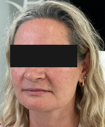 Radiesse biostimulator before treatment — Dr. Soheila Eskandari, Dubai