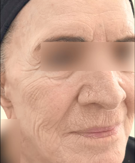 Sculptra before 01