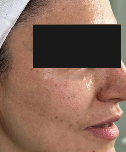 Sculptra before treatment for collagen renewal — Dr. Soheila Eskandari, Dubai