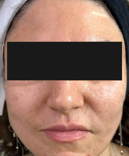 Sculptra before 03