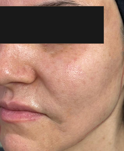 Sculptra before 04