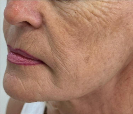 Sculptra before 05