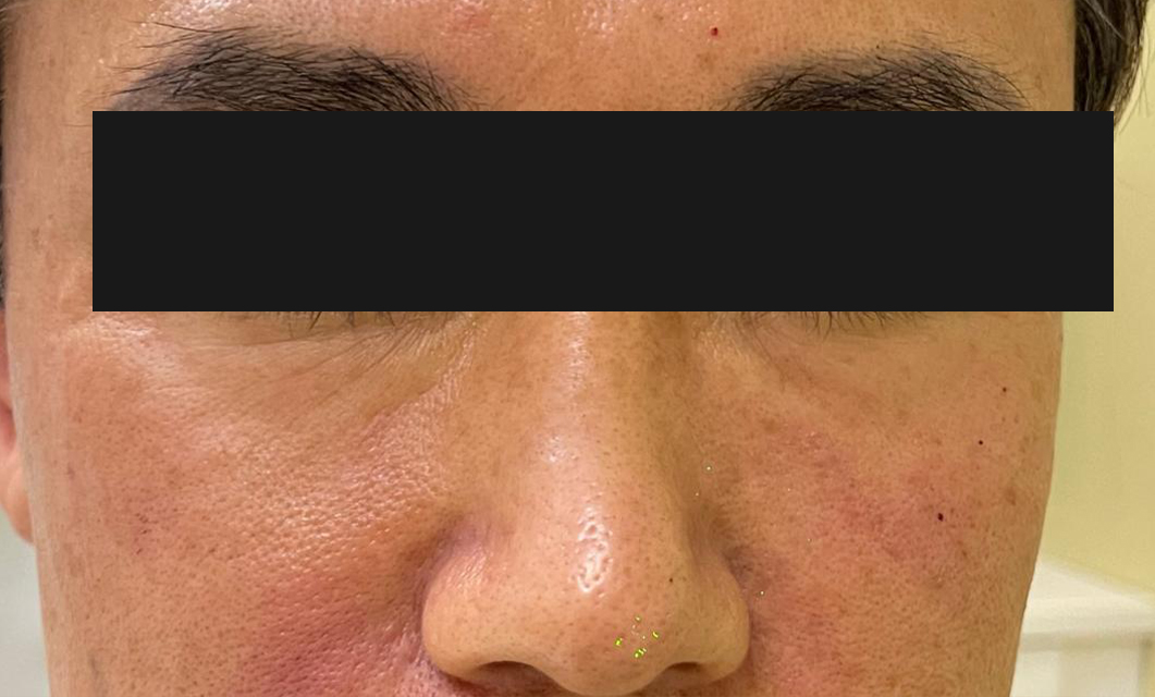 Under-Eye Filler after 01