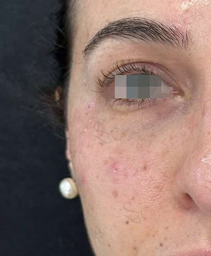 Under-Eye Filler after 02
