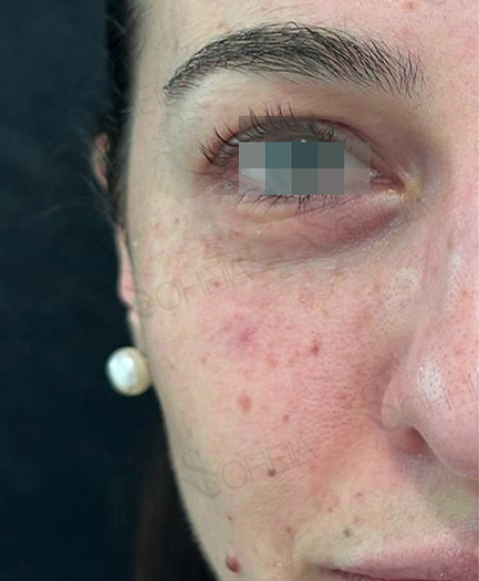 Under-Eye Filler before 02