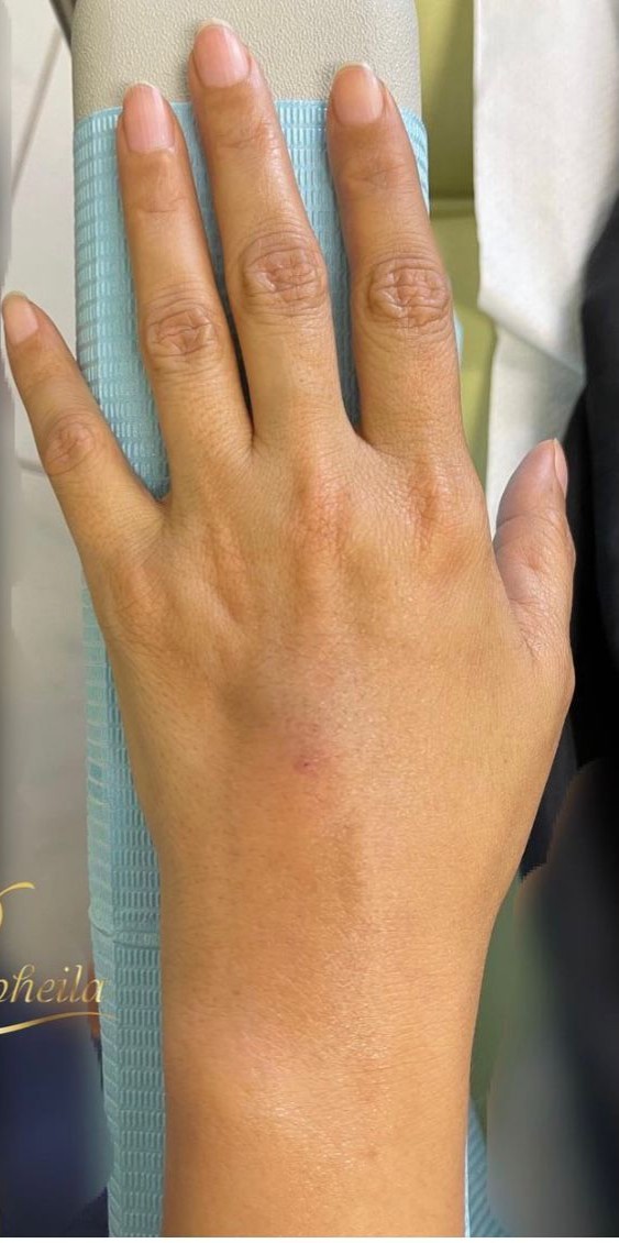 hand-0-after