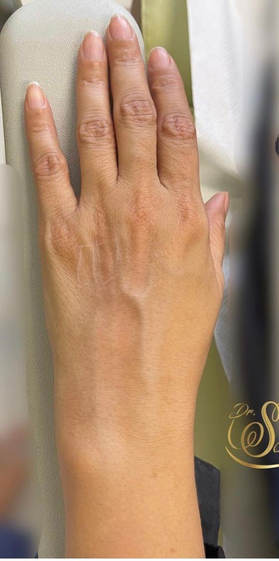 hand-0-before
