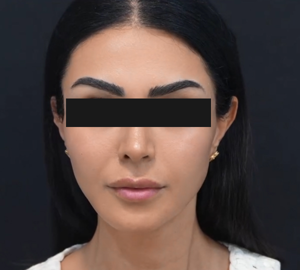 حشو الخدين بعد الساعة 1 صباحًا