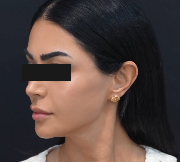 حقن الخدود بعد الساعة 2 صباحًا