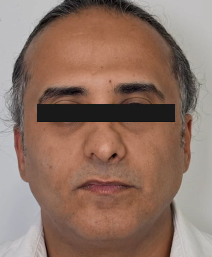 Face contouring with filler after — Dr. Soheila Eskandari, Dubai