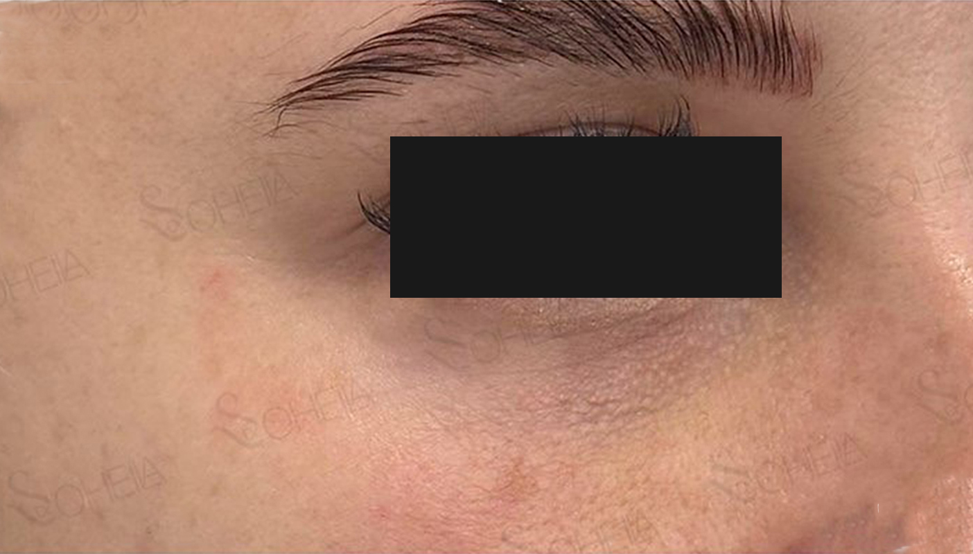 Under-Eye-Filler-after-04