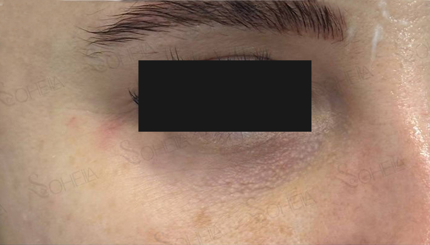 Under-Eye-Filler-before-04
