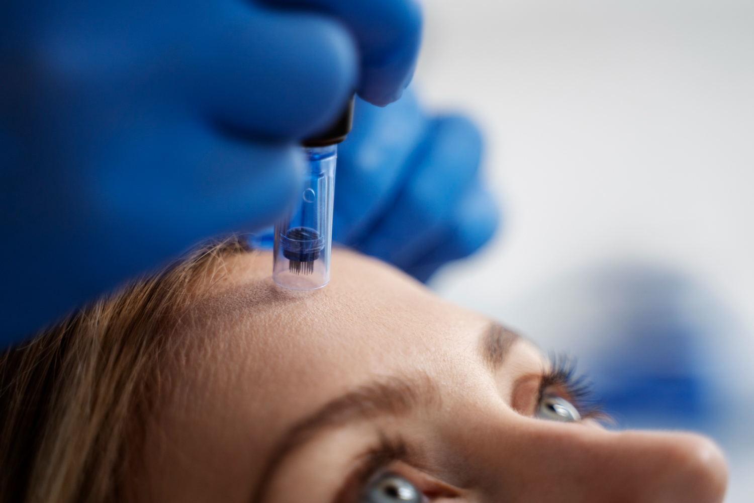 Exosome microneedling