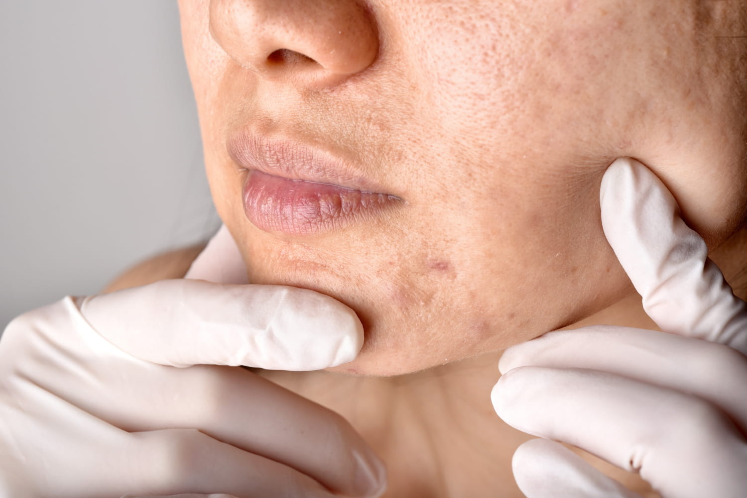 قطع الألياف تحت الجلد لعلاج ندبات حب الشباب Subcision for Acne Scars