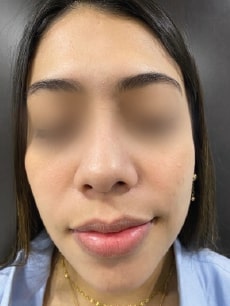 HA High — Scar appearance — after treatment; manufacturer case by Dr. Maira González (Venezuela)