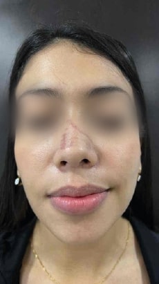HA High — Scar appearance — before treatment; manufacturer case by Dr. Maira González (Venezuela)