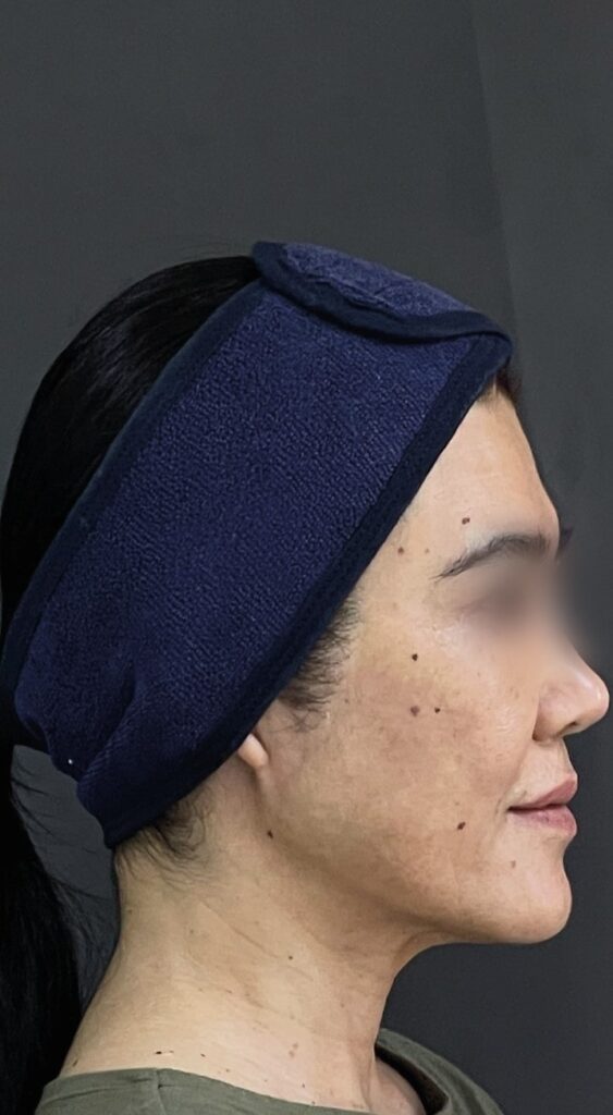 HA Low — Facial reshaping — after treatment; manufacturer case by Dr. Eduardo Ortega (Peru)