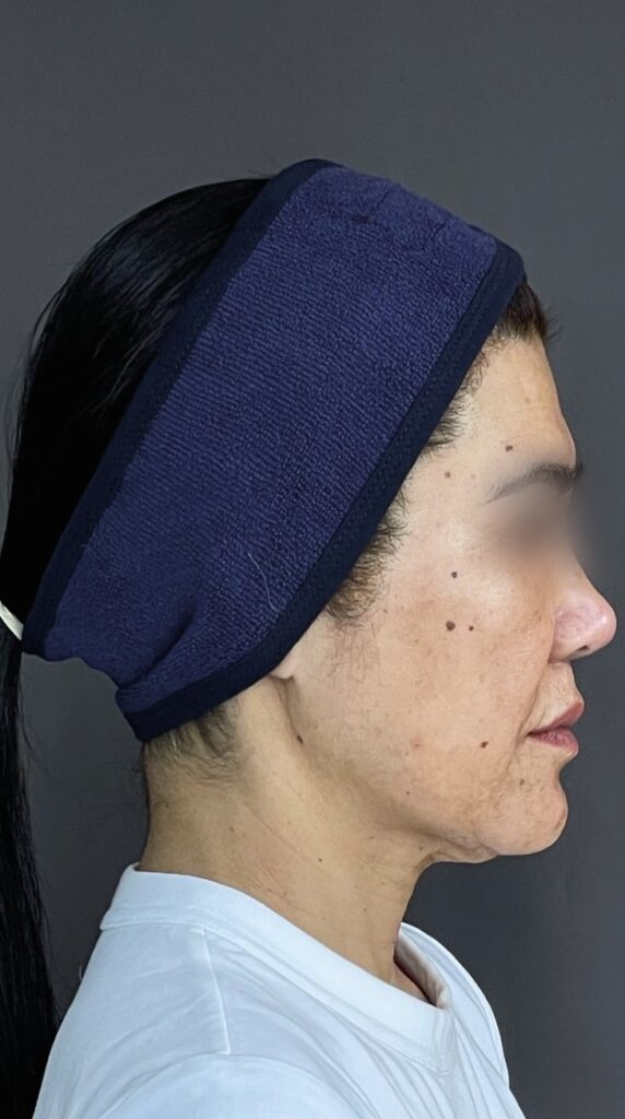 HA Low — Facial reshaping — before treatment; manufacturer case by Dr. Eduardo Ortega (Peru)