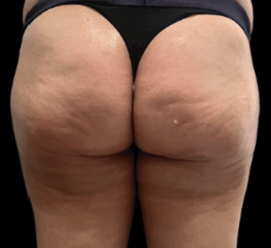 HA Medium — Cellulite — after treatment; manufacturer case by Dr. Mariana Martha Cruz Roncal (Mexico)