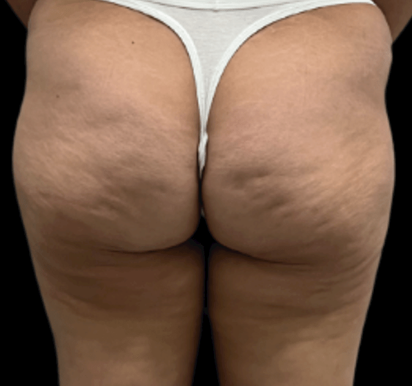 HA Medium — Cellulite — before treatment; manufacturer case by Dr. Mariana Martha Cruz Roncal (Mexico)