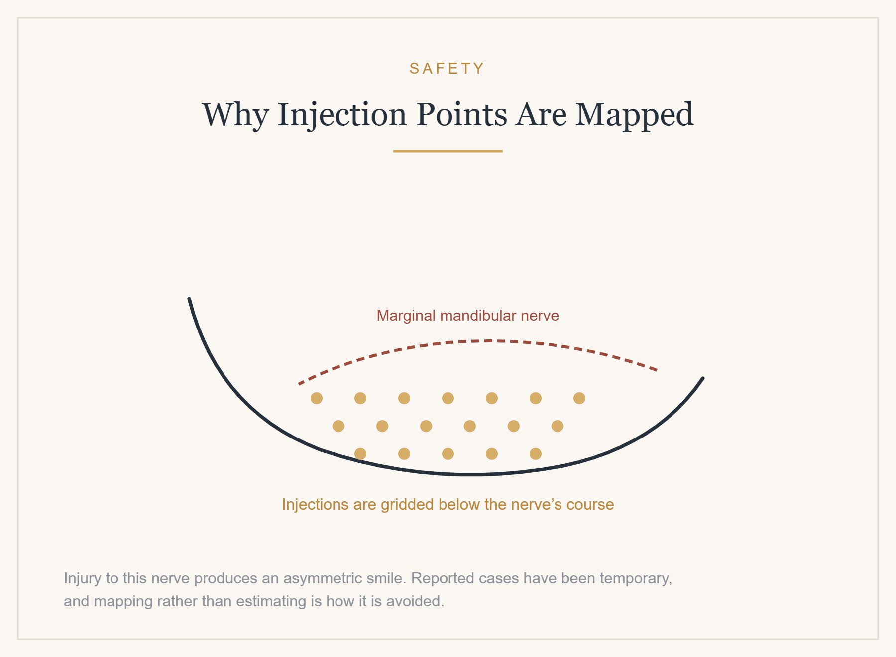 The marginal mandibular nerve and why injection mapping matters